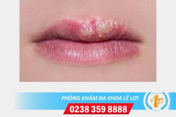 Nơi điều trị mụn rộp sinh dục ở môi nhanh khỏi