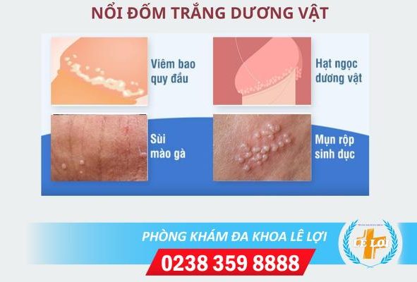 Nguyên nhân nổi đốm trắng vùng kín nam