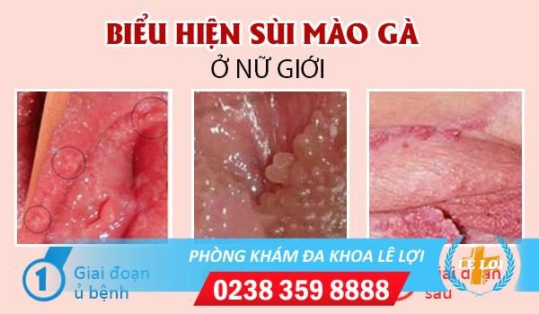 Biểu hiện sùi mào gà âm đạo qua từng giai đoạn