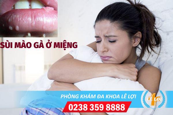 Hình ảnh sùi mào gà miệng: Nhận biết sớm, trị nhanh hết