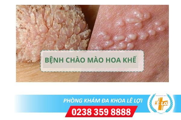 Dấu hiệu bệnh chào mào hoa khế