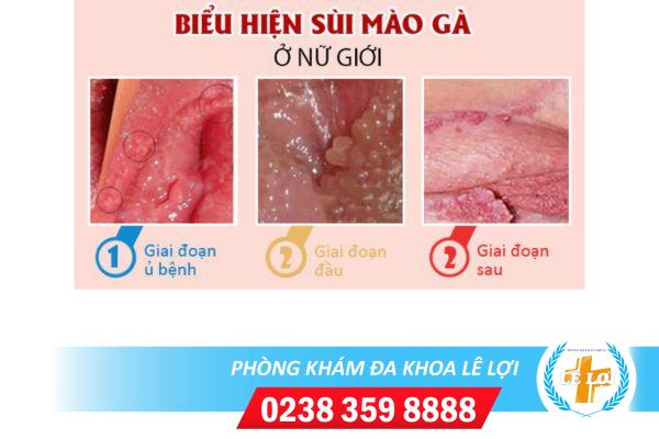 Mắc bệnh sùi mào gà chữa như thế nào?