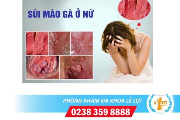 Cách trị mụn sùi mào gà phổ biến, hiệu quả cao