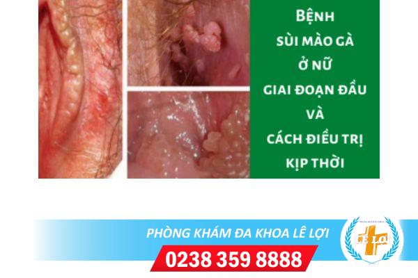 Cách điều trị HPV gây sùi mào gà hiệu quả