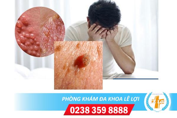 Dấu hiệu sùi mào gà như thế nào?