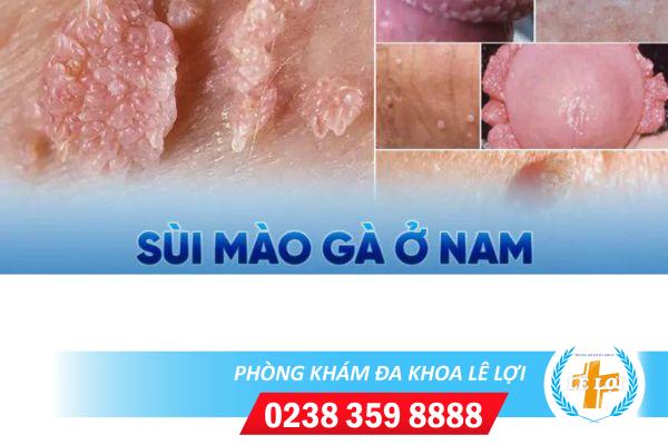 Dấu hiệu nhận biết sùi mào gà lành tính