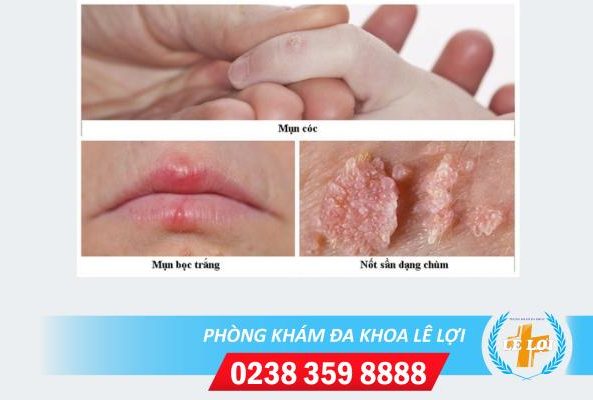 Khám hpv ở đâu uy tín kết quả chính xác bảo mật?