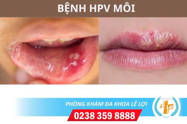 Bệnh herpes ở môi là gì dấu hiệu và cách chữa