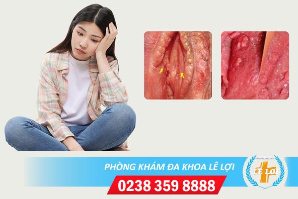 Dấu hiệu bệnh sùi mào gà ở phụ nữ giai đoạn đầu