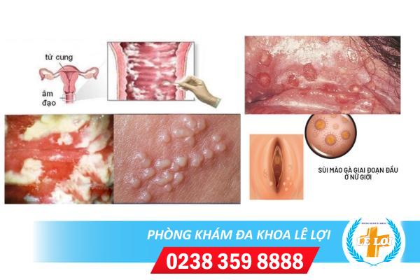 Đốm trắng ở vùng kín nữ là dấu hiệu bệnh gì?