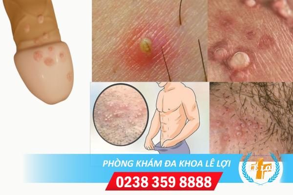 Mọc mụn trắng ở vùng kín nam giới nguyên nhân và cách chữa