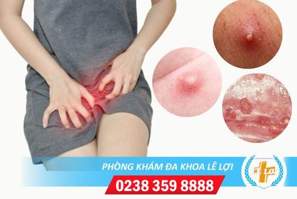 Bị nổi mụn trắng ở cô bé là bị bệnh gì?