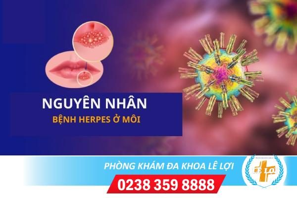 Cách trị Herpes ở môi miệng nhanh khỏi