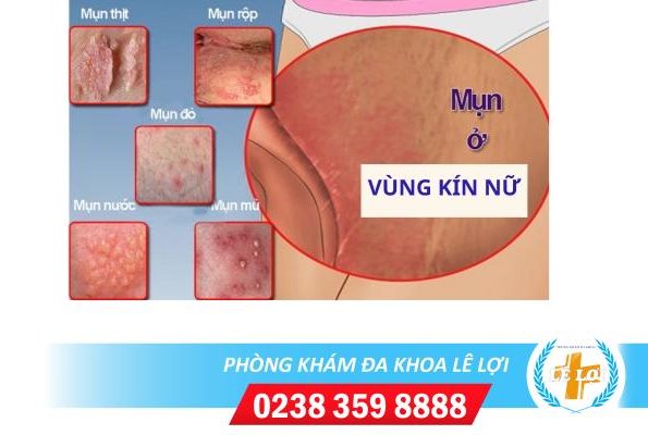 Mụn mủ vùng kín nữ: Biểu hiện bệnh nguy hiểm