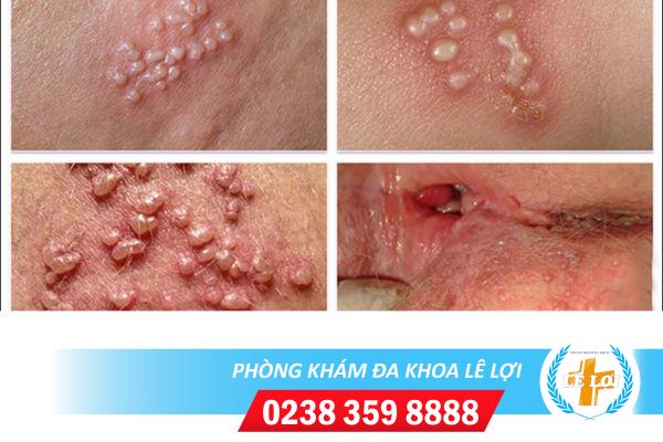 Dấu hiệu Herpes dễ nhận biết