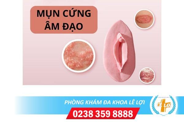 Mụn cứng âm đạo là dấu hiệu bệnh gì?