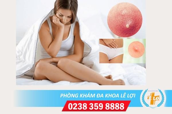 Mụn đầu trắng vùng kín nữ là bệnh gì?