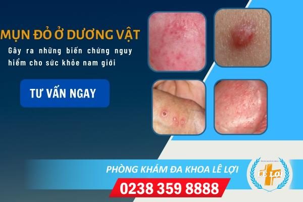 Mụn đỏ ở cậu nhỏ là bị bệnh gì?