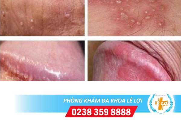 Cách điều trị mụn nước vùng kín nam nhanh khỏi