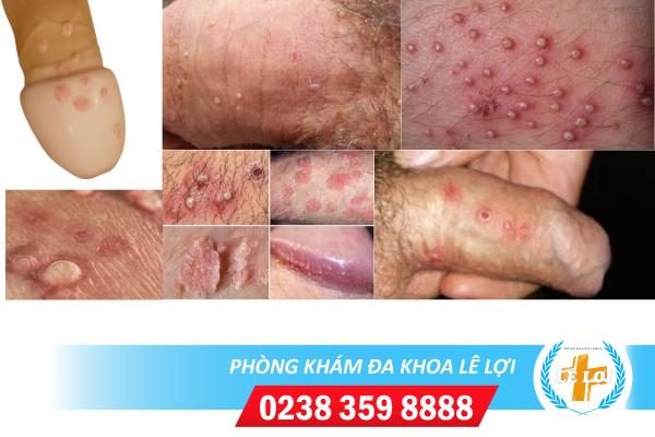 Nổi mụn dương vật là bị bệnh gì?