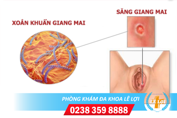 Giang mai ở hậu môn dấu hiệu, nguyên nhân và cách điều trị