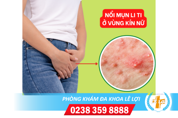 Mụn li ti vùng kín: Nguyên nhân và cách trị hiệu quả