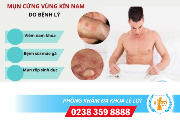 Mụn cứng vùng kín nam là bệnh gì?