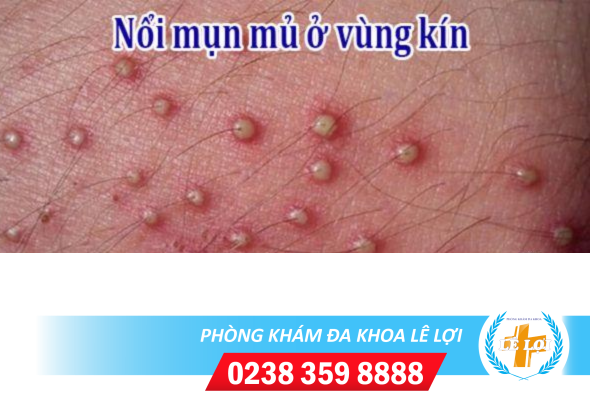 Mụn mủ vùng kín nam: Nguyên nhân và cách chữa trị