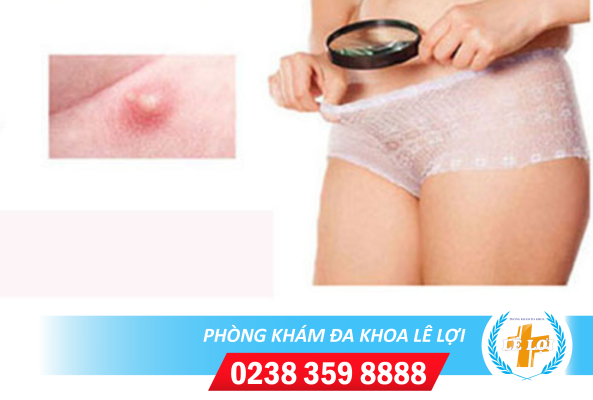 Thận trọng khi nổi mụn trắng ở vùng kín