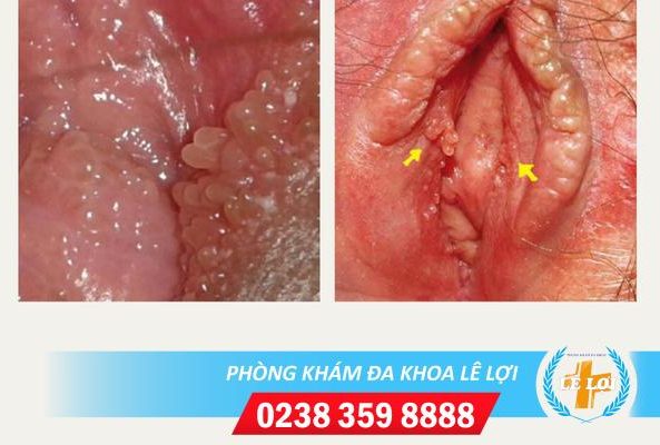 Hình ảnh gai sinh dục và dấu hiệu nhận biết bệnh