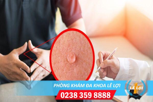 Dấu hiệu dễ nhận biết HPV nam giới