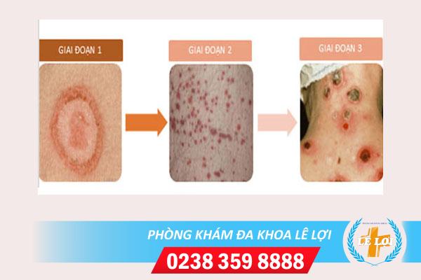 Dấu hiệu giang mai ở miệng, cần khám chữa sớm