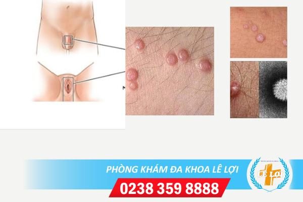 Mụn cơm sinh dục nguy hiểm không dấu hiệu nhận biết