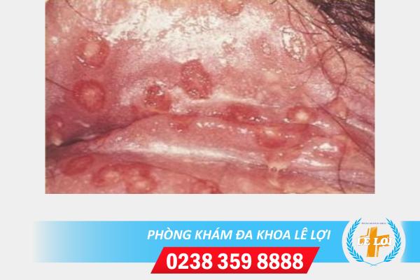 Mụn nước vùng kín nữ là dấu hiệu của bệnh gì?