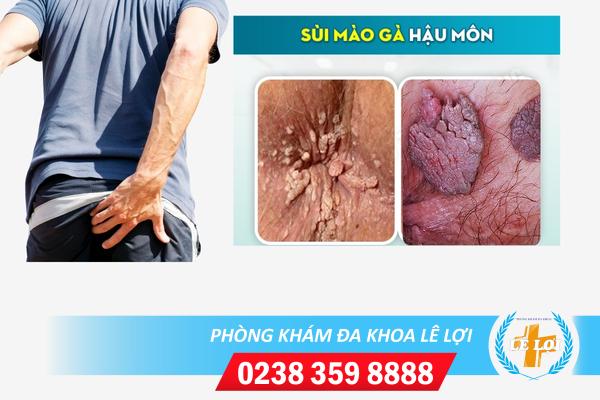 Sùi mào gà ở hậu môn và biểu hiện lâm sàng