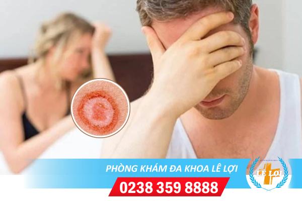 Dấu hiệu bệnh giang mai và cách điều trị