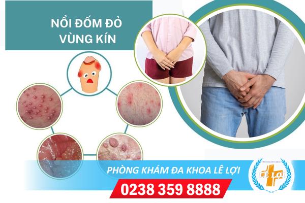 Nguyên nhân nổi đốm đỏ ở vùng kín và cách điều trị