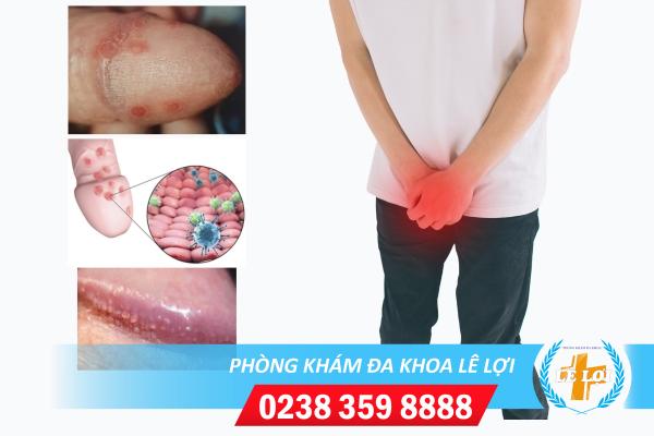 Nguyên nhân đầu dương vật nổi mụn đỏ