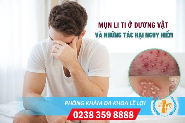 Nổi mụn li ti dương vật là bị bệnh gì?