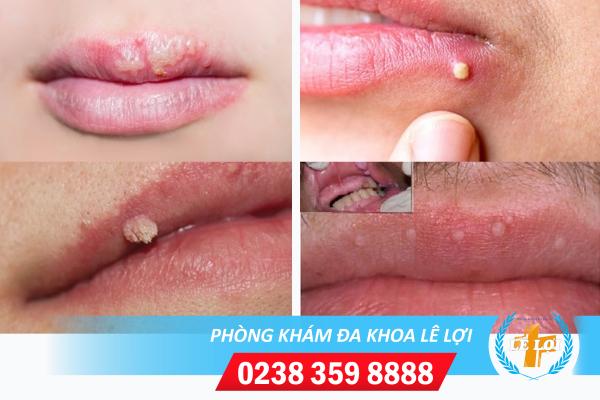 Nổi mụn trắng ở môi là bị bệnh gì?