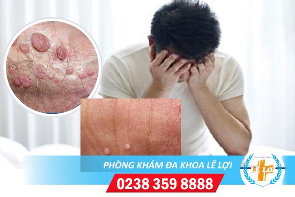 Cách chữa sùi mào gà vùng kín nam hiệu quả nhanh