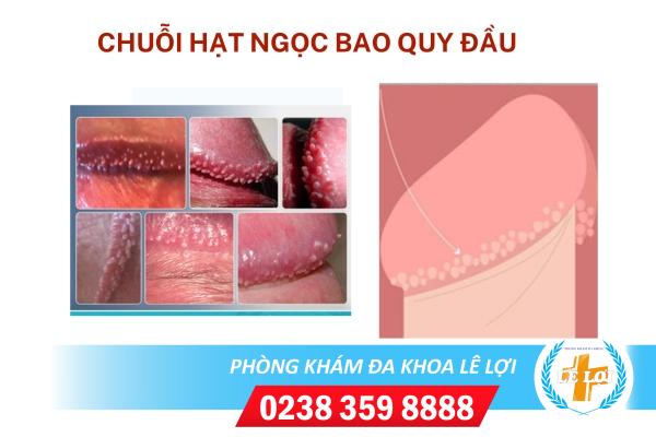 Chuỗi hạt ngọc bao quy đầu là bệnh gì nguy hiểm không?