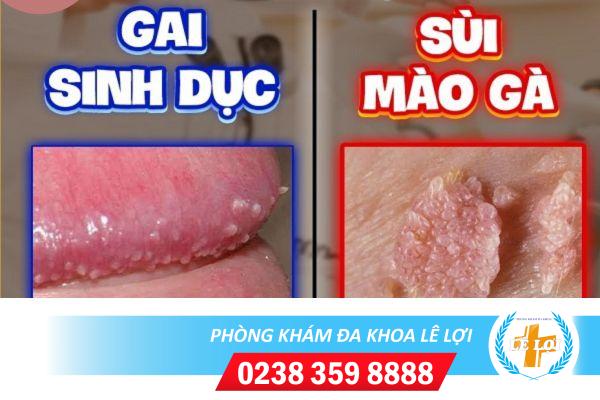 Dấu hiệu dễ phân biệt gai sinh dục và sùi mào gà