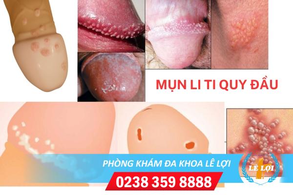 Mụn li ti quy đầu có sao không?