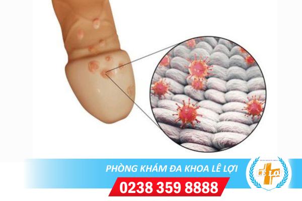 Cách chữa sùi mào gà đầu khấc không đau, nhanh khỏi