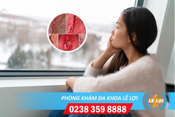 Chữa sùi mào gà vùng kín nữ bằng cách nào?