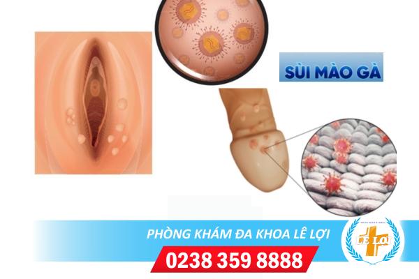 Bệnh sùi mào gà – Một trong các bệnh xã hội nguy hiểm hiện nay