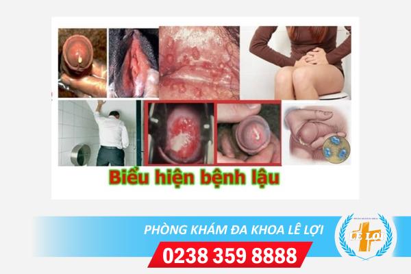 bieu-hien-cua-benh-lau