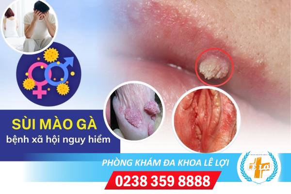 Chữa sùi mào gà bằng cách nào?