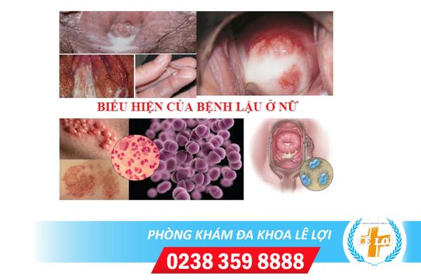 dau-hieu-benh-lau-o-phu-nu